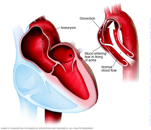 Aortenaneurysma und Dissektion