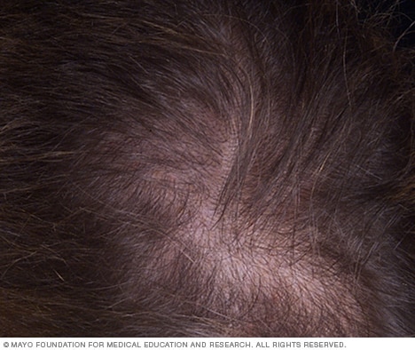 Frauen neigen dazu, entlang des Scheitels Haare zu verlieren.