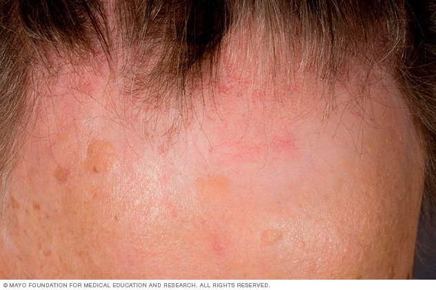 Es kommt immer häufiger vor, dass Frauen in den Wechseljahren an frontaler fibrosierender Alopezie leiden, bei der sich der Haaransatz nach hinten bewegt.