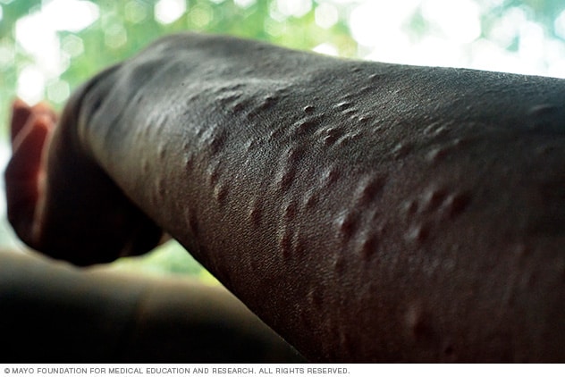 Arm mit Beulen bedeckt, die von Poison Ivy verursacht wurden