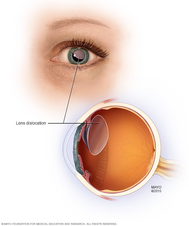 Eine dislozierte Linse im Auge