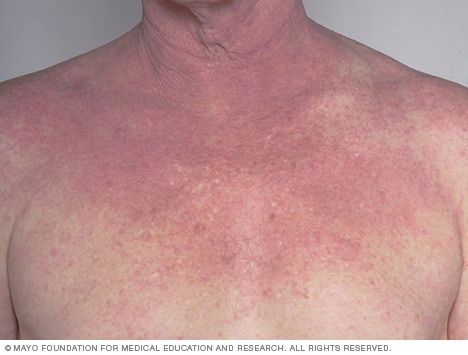 Atopische Dermatitis auf der Brust