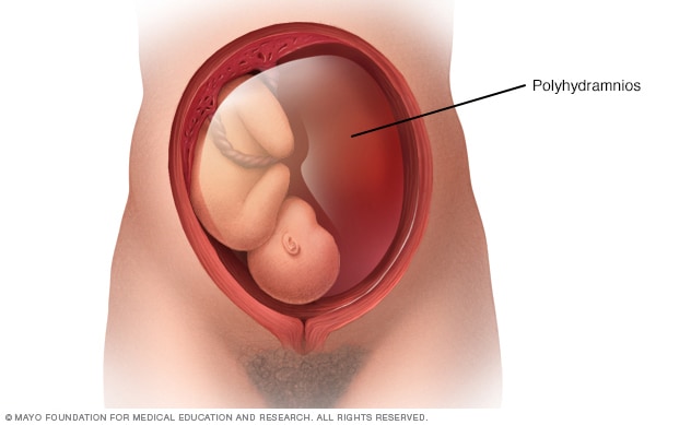 Überschüssiges Fruchtwasser umgibt das Baby in der Gebärmutter (Polyhydramnion)