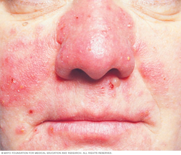 Rhinophym