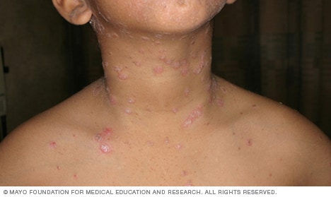 Psoriasis guttata 