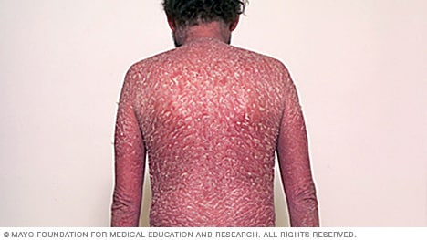 Erythrodermische Psoriasis