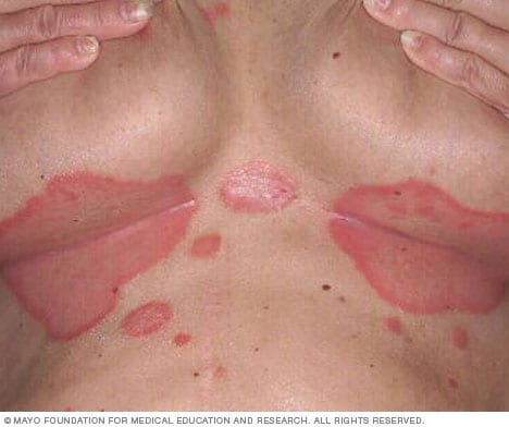 Inverse Psoriasis