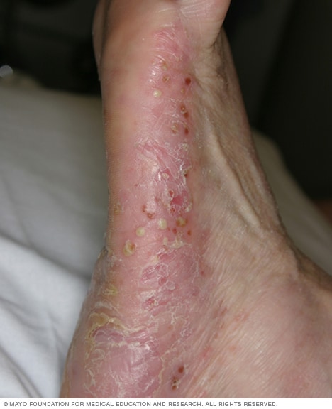Pustulöse Psoriasis 