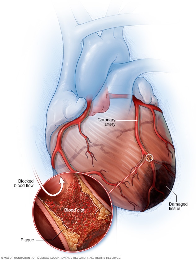   Blockierte Arterie und verletztes Gewebe bei einem Herzinfarkt 