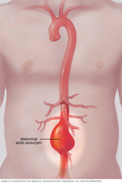 Bauchaortenaneurysma