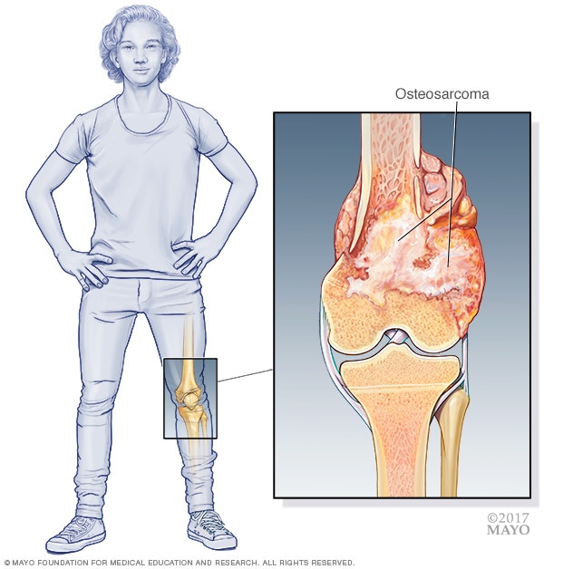 Osteosarkom 