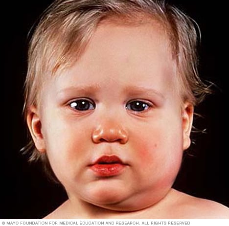 Foto zeigt Kind mit Mumps