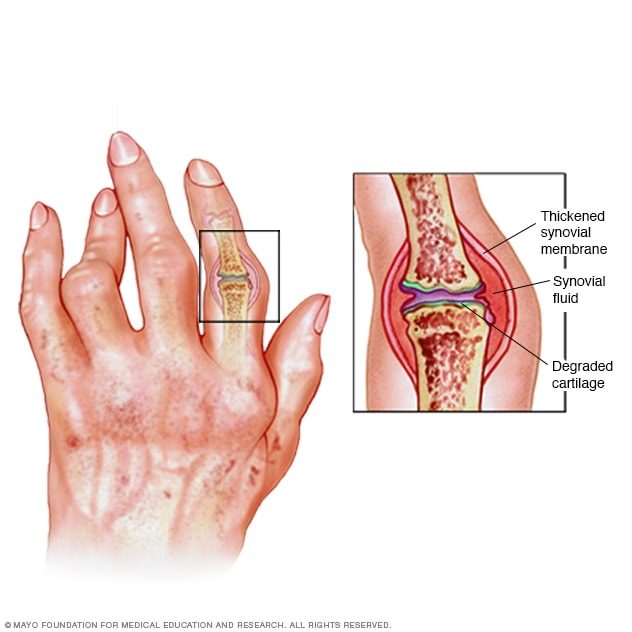 Entzündung der rheumatoiden Arthritis