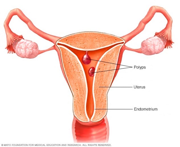 Uteruspolypen