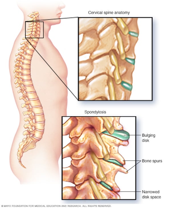 Zervikale Spondylose