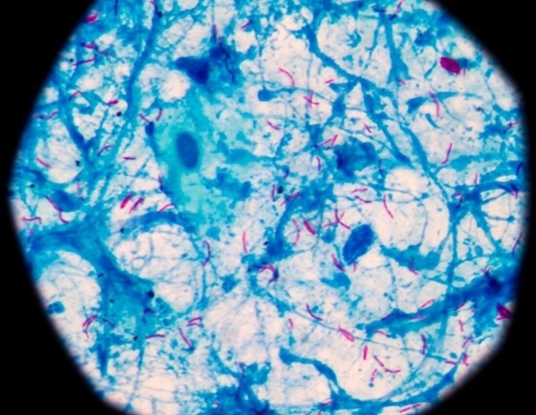 Forscher der University of Oxford haben heute über Ergebnisse einer Studie berichtet, in der untersucht wurde, ob zuvor identifizierte Korrelate des Schutzes im Zusammenhang mit dem Risiko einer ausgewachsenen Tuberkulose (TB)-Erkrankung auch mit dem Risiko einer Infektion durch die Bakterien verbunden sein könnten, die TB verursachen. In ihrem in Nature Communications veröffentlichten Artikel über die TB020-Studie stellten die Forscher fest, dass bestimmte Korrelate des Schutzes – Entzündung und Aktivierung des Immunsystems (wobei der Körper auf eindringende Krankheitserreger wie Viren und schädliche Bakterien reagiert) – mit der Wahrscheinlichkeit von sich mit Mycobacterium tuberculosis (M.tb) infizieren, dem Bakterium, das die TB-Krankheit verursacht. …