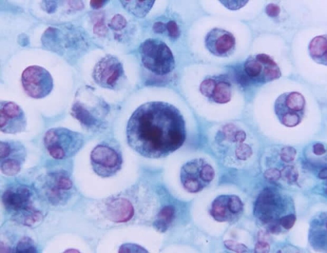 Die Knochengesundheit erfordert eine ausgewogene Aktivität verschiedener Knochenzelltypen, einschließlich knochenbildender Osteoblasten und knochenresorbierender Osteoklasten. Osteoporose tritt auf, wenn Osteoklasten ohne ausreichende Knochenbildung dominieren, um dies zu kompensieren. In neuen Forschungsergebnissen, die im Journal of Bone and Mineral Research veröffentlicht wurden, wurden erhöhte Blutspiegel eines bestimmten Chemokins oder kleinen Signalproteins, das die Bildung von Osteoklasten fördert, mit einem höheren Risiko für Hüftfrakturen bei Männern in Verbindung gebracht. An der Studie nahmen 55 Männer und 119 Frauen teil, die durchschnittlich 6,3 Jahre nach der Blutentnahme eine Hüftfraktur erlitten hatten. Die Teilnehmer wurden individuell auf Kontrollen abgestimmt, die keine Hüftfrakturen entwickelten. Die Forscher …