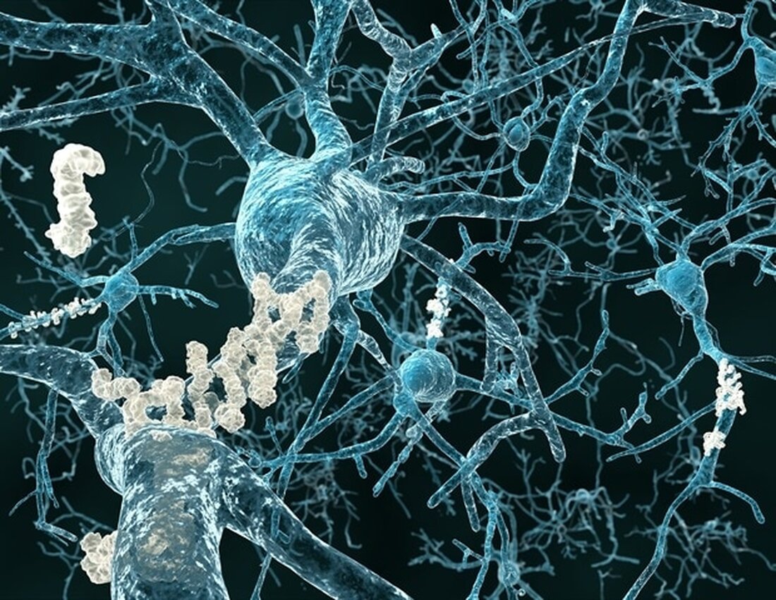 Forscher der Case Western Reserve University haben einen Mechanismus im Gehirngewebe identifiziert, der erklären könnte, warum Frauen anfälliger für die Alzheimer-Krankheit sind – ein Befund, der ihrer Meinung nach dazu beitragen könnte, neue Medikamente zur Behandlung der Krankheit zu entwickeln. Konkret fanden die Forscher heraus, dass das weibliche Gehirn im Vergleich zum männlichen Gehirn eine höhere Expression eines bestimmten Enzyms aufweist, was zu einer stärkeren Anreicherung eines Proteins namens Tau führt. Das Tau-Protein ist für die Bildung toxischer Proteinklumpen in den Nervenzellen des Gehirns von Alzheimer-Patienten verantwortlich. Das Enzym, bekannt als Ubiquitin-spezifische Peptidase 11 (USP11), ist X-chromosomal, was bedeutet, dass …