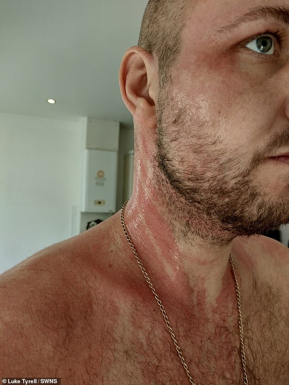 Luke Tyrell, 34, aus Clitheroe, erlitt eine schwere allergische Reaktion auf Johnsons Babyshampoo, die er als ein Gefühl wie eine Säureverbrennung beschrieb Tyrell sagte, er habe das Unternehmen benachrichtigt, konnte aber keinen Anruf erhalten und beschrieb ihre Antwort als „Sumpfstandard“. Nachdem er seine Erfahrungen in den sozialen Medien geteilt hatte, kamen andere heraus, um ähnliche Geschichten zu teilen, nachdem sie Jonhsons Babyshampoo verwendet hatten Die Muttergesellschaft Johnson &#038; Johnson stand in den letzten Jahren wegen potenziell verheerender Nebenwirkungen für Menschen, die ihr Babypuder verwendet haben, unter Beschuss Ein Brite, der unter einer schweren allergischen Reaktion auf Johnsons Babyshampoo litt, beschrieb &hellip;