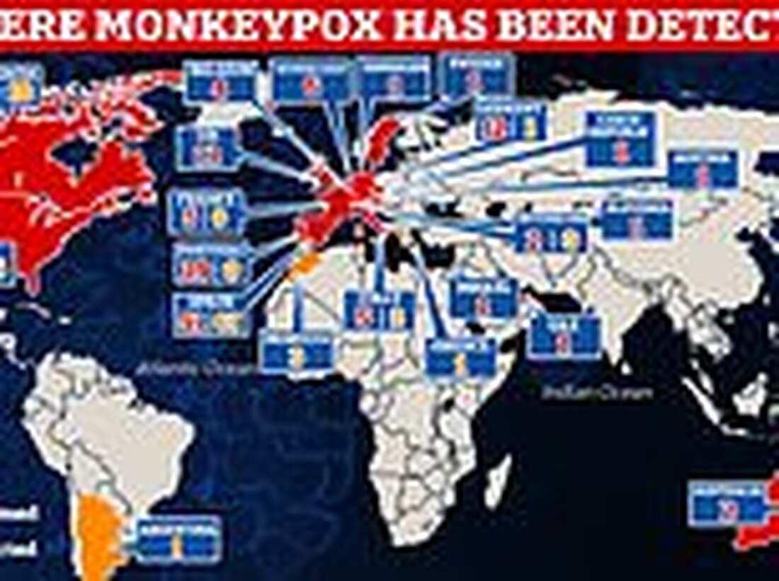 Den Briten wurde bis in die 1970er Jahre routinemäßig die Pockenimpfung angeboten, kurz danach wurde das Virus ausgerottet Die schwindende Immunität gegen Virenfamilien könnte erklären, warum Affenpocken-Ausbrüche häufiger werden Obwohl Imvanex nicht für Affenpocken entwickelt wurde, ist es zu 85 % wirksam, da die beiden Viren so ähnlich sind Dr. Romulus Breban, ein Forscher am Pasteur-Institut in Paris, sagte, der Anstieg warte darauf, zu geschehen. Professor Neil Mabbott von der University of Edinburgh sagte, die unter 50-Jährigen seien anfälliger Anzeige . Quelle: Dailymail UK