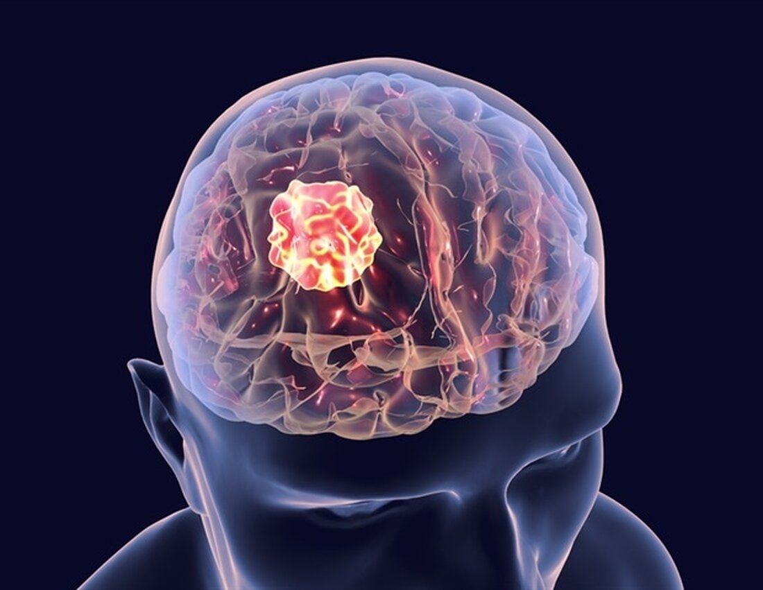 Eine Studie von Ludwig Cancer Research hat eine Kombination aus drei bestehenden Medikamenten identifiziert, die das Überleben in Mausmodellen des tödlichen Hirntumors Glioblastoma multiforme (GBM) signifikant verlängert. Forscher um Douglas Hanahan von Ludwig Lausanne berichten in der aktuellen Ausgabe von Cancer Cell, wie die in der Kombination verwendeten Medikamente – ein Antidepressivum, ein Immun-Checkpoint-Blockade-Antikörper und ein Maus-Analogon einer Krebstherapie, die allein keinen Überlebensvorteil gegen GBM bieten – ; synergieren, um starke therapeutische Immunantworten gegen den Tumor auszulösen. Unsere Untersuchung zeigt das große Potenzial der Wiederverwendung von Arzneimitteln für die Krebstherapie. Wir haben hier gezeigt, dass drei umfassend charakterisierte Medikamente, die &hellip;