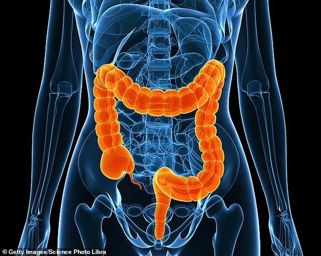 Etrasimod behandelt Colitis ulcerosa, indem es an Immunzellen bindet und diese daran hindert, fälschlicherweise gesundes Gewebe in der Darmschleimhaut anzugreifen In einer kürzlich durchgeführten Studie wurde bei 27 % der Patienten, die auf keine andere Behandlung angesprochen hatten, nach 12 Wochen eine Remission festgestellt; 32 % waren nach einem Jahr beschwerdefrei Colitis ulcerosa kann schwächend sein und blutigen Durchfall, extreme Müdigkeit, Appetitlosigkeit und Gewichtsverlust verursachen Es betrifft etwa 146.000 Menschen in Großbritannien; Experten schlagen vor, dass viele weitere nicht diagnostiziert werden könnten Patienten mit schweren Darmerkrankungen könnten von einem neuen Medikament profitieren, das ihre belastenden Symptome innerhalb von nur drei &hellip;