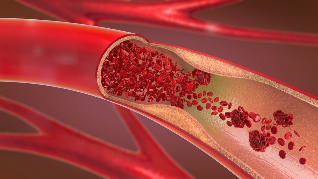 In einer kürzlich veröffentlichten Studie in Fortgeschrittene Werkstoffeentwickelte ein Forscherteam ein neuartiges biologisch abbaubares Gefäßtransplantat mit kleinem Durchmesser, das die Bildung von elastinhaltigen Strukturen in der Intima-Media unterstützt, was für die normale Funktion der Arterie wichtig ist. Lernen: Schnelle Regeneration einer Neoarterie mit elastischen Lamellen. Bildquelle: Christoph Burgstedt/Shutterstock Hintergrund Arterielle Schäden, die durch Erkrankungen wie schwere Atherosklerose verursacht werden, können zu Myokardinfarkt und Tod führen. Während autologe Gefäßtransplantate aus Radialarterien, inneren Brustarterien oder Stammvenen ideal sind, greifen Patienten mit Vorerkrankungen häufig auf synthetische Transplantate zurück. Im Handel erhältliche synthetische Transplantate, die aus Materialien wie Polytetrafluorethylen hergestellt sind, werfen Probleme auf, …