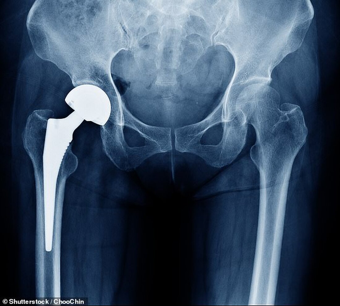 Etwa 15 % der Briten haben genetische Merkmale, die das Immunsystem dazu bringen, Gewebe um das Material in Gelenkimplantaten anzugreifen, was Schmerzen und Schwellungen verursacht Studien belegen seit langem, dass etwa ein Fünftel der Menschen auf ein künstliches Gelenk aus Kobalt-Chrom schlecht reagiert Bisher wussten Experten nicht warum, was bedeutete, dass Ärzte nicht sagen konnten, ob ein Patient schlecht auf sein neues Gelenk reagieren würde oder nicht Ein Speichelabstrich vor Ihrem Hüftgelenkersatz könnte vorhersagen, ob das Verfahren funktioniert. Britische Forscher haben herausgefunden, dass DNA-Signale, die in Speichel- und Blutproben lauern, mit einer nachteiligen Reaktion auf Materialien in den meisten Gelenkimplantaten …