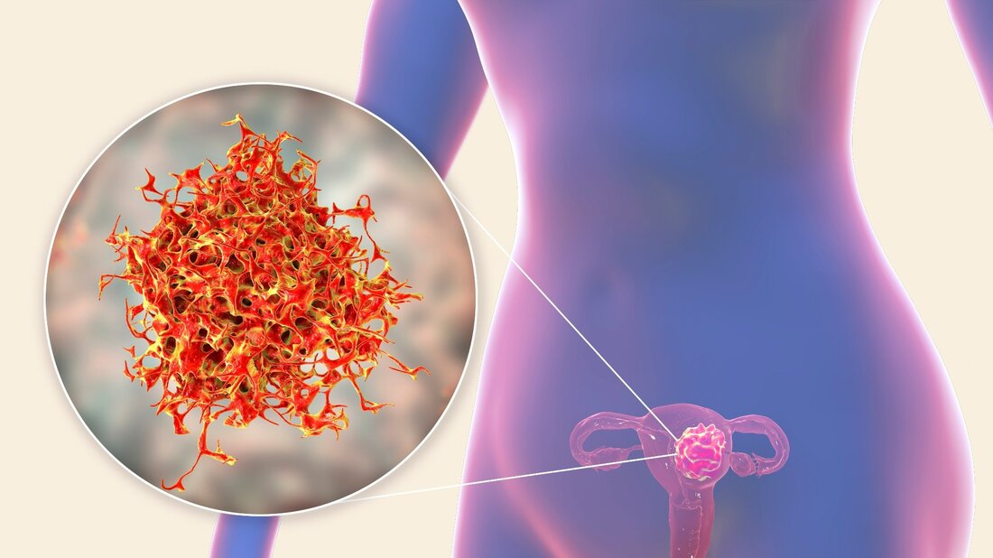 Gebärmutterkrebs gilt als eine der häufigsten gynäkologischen Krebserkrankungen. In den letzten zwei Jahrzehnten kam es in den USA zu einem Anstieg der Sterblichkeits- und Inzidenzraten, was zu mehr als 65.950 Neuerkrankungen und voraussichtlich 12.550 Todesfällen im Jahr 2022 führte. Es wurde berichtet, dass es zu einer übermäßigen Östrogenexposition und einem hormonellen Ungleichgewicht von Progesteron und Östrogen gekommen sei wesentliche Risikofaktoren für Gebärmutterkrebs. Daher wird vermutet, dass synthetische östrogene Verbindungen wie endokrin wirkende Chemikalien (EDCs) das Risiko für Gebärmutterkrebs erhöhen, da sie hormonelle Wirkungen verändern können. Die Verwendung verschiedener EDCs in Haarprodukten wurde mit hormonempfindlichen Krebsarten wie Eierstock- und Brustkrebs in &hellip;