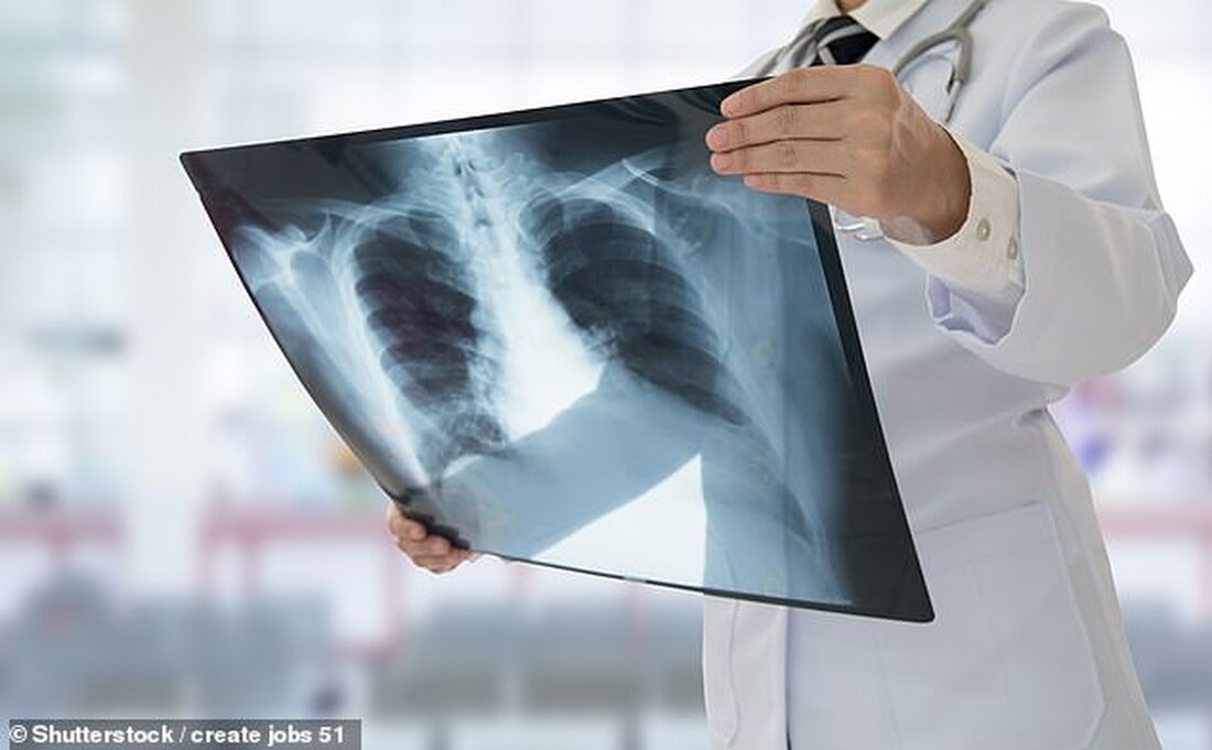 Kürzlich ging ich mit Brustbeschwerden ins Krankenhaus, wurde aber entlassen. Ich muss für einen myokardialen Perfusionsscan zurück, für den mir eine kleine Menge radioaktiver Tracer injiziert werden muss. Ich bin 81 und bei guter Gesundheit, aber ich mache mir Sorgen. Colin Buckley, King&#8217;s Lynn, Norfolk. Es muss ein wenig verwirrend gewesen sein, dass man Ihnen versichert hat, dass alles in Ordnung ist, damit Sie entlassen werden können, nur um weitere Untersuchungen zu benötigen. Die gute Nachricht ist, dass ein Herzinfarkt ausgeschlossen wurde. Die andere, viel häufigere Ursache für Brustschmerzen ist Angina pectoris, ein krampfartiges Unbehagen, das auftritt, wenn der Herzmuskel &hellip;