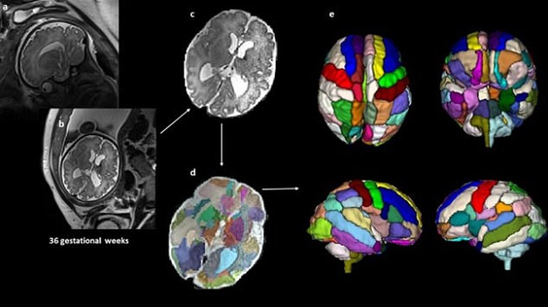 Autismus kann im Mutterleib durch Scans des Gehirns von Babys entdeckt werden, sagen Wissenschaftler Babys, die später Autismus entwickelten, hatten drei größere Teile des Gehirns Die Ergebnisse deuten darauf hin, dass eine Erhöhung vorhersagen könnte, welche Babys später im Leben Autismus entwickeln Autismus könnte im Mutterleib entdeckt werden – durch die Analyse der Gehirnscans von sich entwickelnden Babys, schlägt eine Studie vor. Forscher der Harvard Medical School untersuchten Ultraschalluntersuchungen von 39 Babys vor ihrer Geburt. Neun Jugendliche, bei denen Autismus diagnostiziert wurde, hatten einen Insellappen, der größer als normal war, wie die Ergebnisse zeigten. Der Bereich des Gehirns überwacht das &hellip;