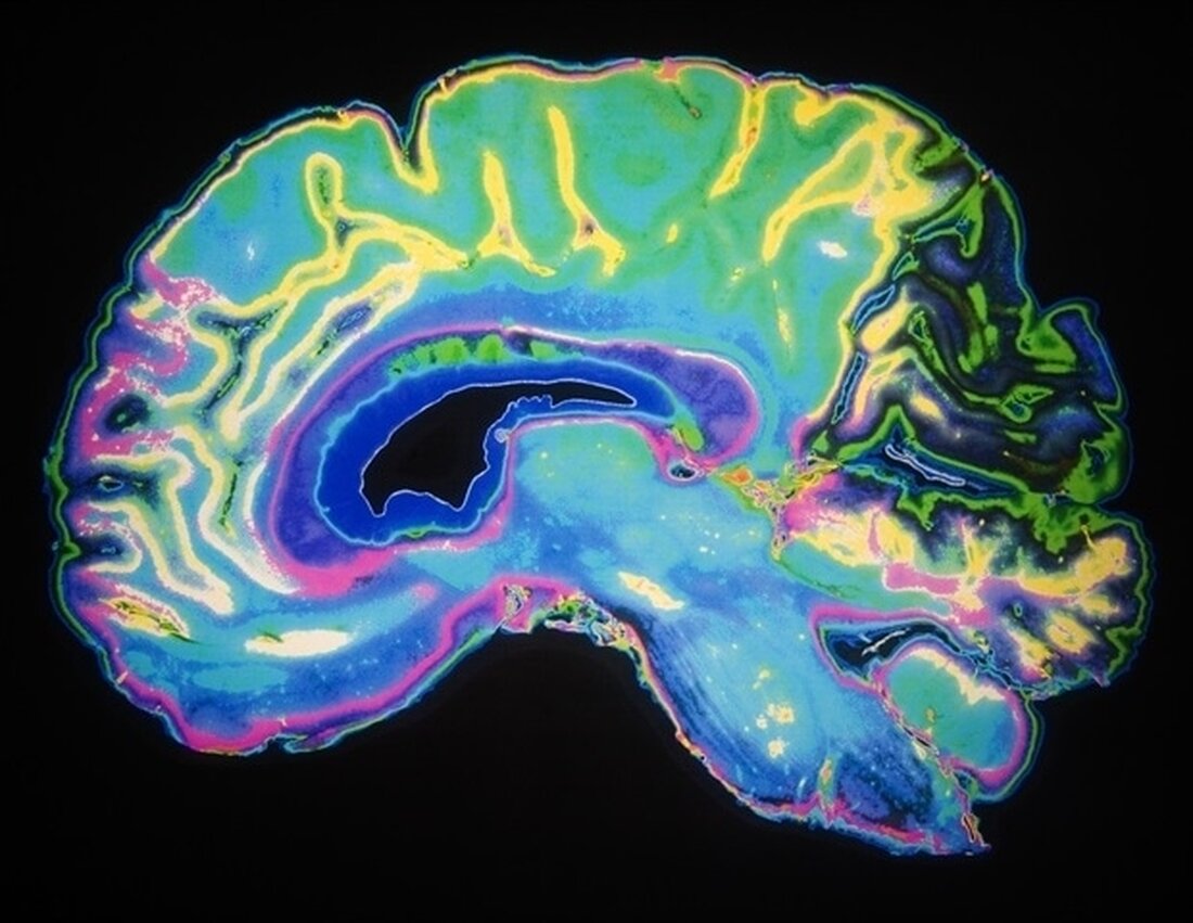 Ein Trauma kann dissoziative Symptome hervorrufen – wie z. B. eine außerkörperliche Erfahrung oder emotionale Taubheit –, die einer Person kurzfristig bei der Bewältigung helfen können, aber negative Auswirkungen haben können, wenn die Symptome über einen längeren Zeitraum anhalten. In einer kürzlich in Neuropsychopharmacology veröffentlichten neuen Studie hat ein Team unter der Leitung von Forschern des McLean Hospital, der größten psychiatrischen Tochtergesellschaft der Harvard Medical School und Mitglied von Mass General Brigham, Regionen innerhalb von Gehirnnetzwerken identifiziert, die miteinander kommunizieren, wenn Menschen unterschiedliche Typen erleben von dissoziativen Symptomen. Dissoziation und schwere dissoziative Störungen wie dissoziative Identitätsstörung oder ‚DIS‘ werden bestenfalls …