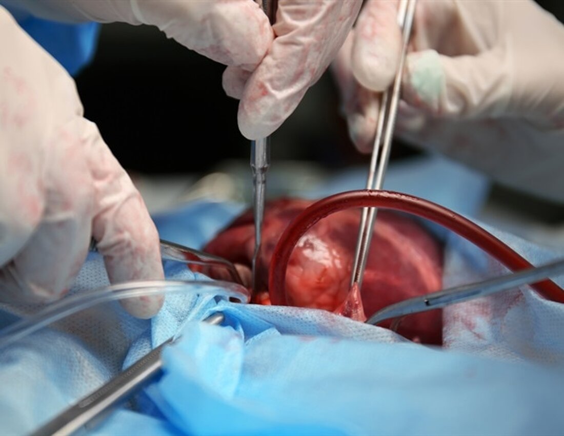 Postoperative Blutungen gehören zu den häufigsten Komplikationen nach Herzoperationen, insbesondere nach Operationen am offenen Herzen. Bei dieser Art von Operation müssen Chirurgen auf einen kardiopulmonalen Bypass zurückgreifen, einen extrakorporalen Kreislauf aus Schläuchen und Maschinen, der die Funktion von Herz und Lunge nachahmt. Dadurch können sie im Inneren des Herzens arbeiten, während dieses still und blutleer bleibt. Trotz seines unbestreitbaren Nutzens beeinflusst die Blutzirkulation außerhalb des Körpers die Anzahl und Funktion der für die Blutgerinnung verantwortlichen Komponenten, der Blutplättchen. Um Blutungen zu verhindern oder auszugleichen, benötigen Patienten daher häufig Bluttransfusionen, was nicht nur ihr Sterberisiko erhöht, sondern auch erhebliche Gesundheitskosten mit …