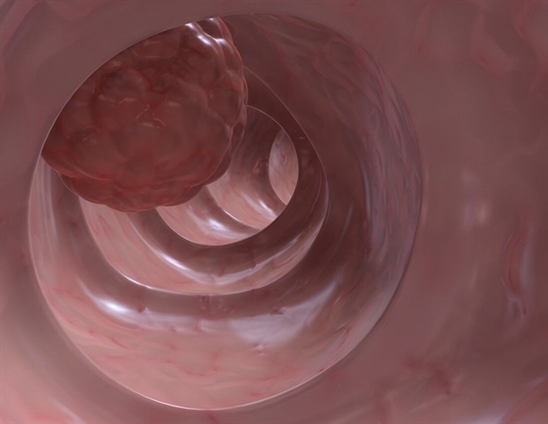 Forscher am Tisch Cancer Institute am Mount Sinai haben ein neues Gen identifiziert, das für das Wachstum von Darmkrebs wesentlich ist, und herausgefunden, dass Entzündungen in der äußeren Umgebung des Tumors zum Wachstum von Tumorzellen beitragen können. Über diese Ergebnisse berichteten die Wissenschaftler im Oktober in Nature Communications. Dies ist das erste Mal, dass Wissenschaftler entdeckt haben, dass die Umgebung eines Darmkrebstumors einen sogenannten „Super-Enhancer“ programmieren kann, einen komplexen DNA-Bereich mit einer hohen Konzentration an Transkriptionsmaschinen, der steuert, ob eine Zelle bösartig ist. Dieser Super-Enhancer – der größte 1–2 % aller Enhancer in der Zelle – reguliert das Gen PDZK1IP1, …