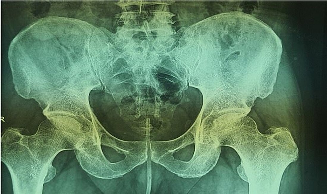 Ein pakistanischer Mann führte ein 18 cm langes Stück Draht in seinen Penis ein, um ihm beim Urinieren zu helfen Mediziner sagten, der Mann habe seit 2 Monaten Schwierigkeiten und Schmerzen beim Wasserlassen Bilder zeigen, wie die Mediziner den Draht mit einer Pinzette aus seinem Penis herauszogen Trotz der Tortur erlitt der Mann Berichten zufolge keine unmittelbaren Komplikationen Ein Mann brauchte ein Stück Elektrokabel, das aus seinem Penis gezogen wurde, nachdem ein DIY-Versuch, seine Probleme beim Wasserlassen zu heilen, dramatisch schief gelaufen war. Der 64-Jährige aus Pakistan hatte sich den 18 cm langen Draht in die Harnröhre geschoben, doch er &hellip;