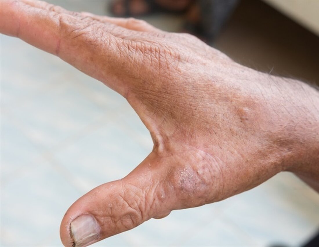 Mehr Kollagen im menschlichen Körper ist nicht immer gut, und Karin Wuertz-Kozak untersucht, wie Krankheiten aufgrund der Zunahme dieses wichtigen Proteins fortschreiten. Wuertz-Kozak erhielt kürzlich mehr als 400.000 US-Dollar vom Congressional Directed Medical Research Program (CDMRP), um neue therapeutische Ansätze für Sklerodermie zu untersuchen, eine chronische Autoimmunerkrankung, bei der es zu einer Überproduktion von Kollagen kommt, die auch als Fibrose bezeichnet wird. Kollagen ist eines der wichtigsten Matrixproteine in Ihrem Körper. Und obwohl ein Kollagenverlust mit zahlreichen Krankheiten in Verbindung gebracht wird, hat eine Überproduktion von Kollagen auch nachteilige Auswirkungen, wie sie bei Sklerodermie zu beobachten sind.“ Karin Wuertz-Kozak, die …