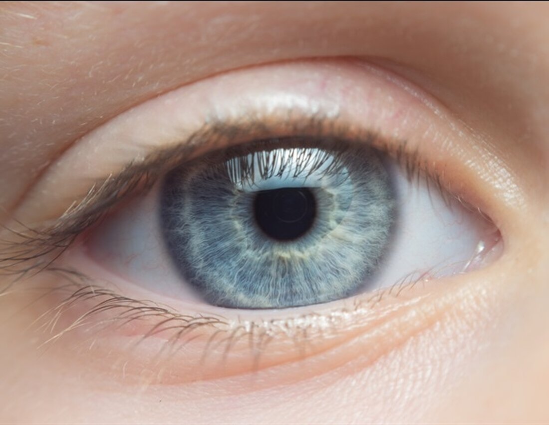 Mithilfe einer neuen Bildgebungstechnik haben Forscher des National Eye Institute festgestellt, dass Netzhautläsionen durch vitelliforme Makuladystrophie (VMD) je nach Genmutation variieren. Die Behandlung dieser Unterschiede kann der Schlüssel zur Entwicklung wirksamer Behandlungen für diese und andere seltene Krankheiten sein. NEI ist Teil der National Institutes of Health. Die langfristige Investition des NEI in die Bildgebungstechnologie verändert unser Verständnis von Augenkrankheiten. Diese Studie ist nur ein Beispiel dafür, wie eine verbesserte Bildgebung subtile Details über die Pathologie einer seltenen Augenkrankheit aufdecken kann, die die Entwicklung von Therapeutika beeinflussen können.“ Michael F. Chiang, MD, NEI-Direktor VMD ist eine erbliche genetische Erkrankung, die …