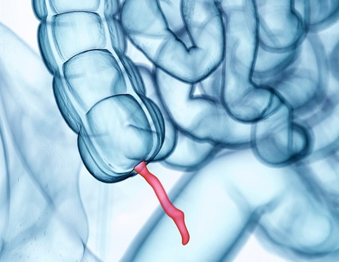 Laut einer Studie in JAMA Oncology, die als erste vererbte Risikofaktoren für diesen seltenen Krebs aufzeigt, trägt jeder 10. Patient mit Blinddarmkrebs eine genetische Keimbahnvariante, die mit einer Krebsprädisposition assoziiert ist. Blinddarmkrebs betrifft jährlich etwa ein oder zwei Menschen pro Million. In der Vergangenheit wurde angenommen, dass Blinddarmkrebs nicht erblich ist, aber seine Seltenheit hat das Verständnis der Merkmale der Krankheit und die Entwicklung von Therapien vor Herausforderungen gestellt. Ein Forschungsteam unter der Leitung von Andreana Holowatyj, PhD, MSCI, Assistenzprofessorin für Medizin und Krebsbiologie am Vanderbilt University Medical Center, analysierte Multigen-Panel-Testdaten eines landesweiten klinischen Testlabors in den USA für insgesamt …