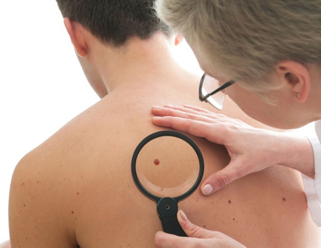 Obwohl das Melanom die schwerste Art von Hautkrebs ist, haben die meisten Patienten gute Chancen, die Krankheit zu überleben. Es gibt Hinweise darauf, dass mehr Fälle von Melanomen bei Patienten überdiagnostiziert werden, bei denen niemals Symptome auftreten würden. Unter Verwendung von Krebsregisterdaten haben Forscher eine Untergruppe von Patienten mit Melanomen im Frühstadium mit fast keinen melanombedingten Todesfällen identifiziert, was möglicherweise Fälle darstellt, die zu einer Überdiagnose beitragen. Die Forschungsergebnisse, die von Wiley online in CANCER, einem Peer-Review-Journal der American Cancer Society, veröffentlicht wurden, können Ärzten dabei helfen, festzustellen, bei welchen Patienten nach Entfernung des Tumors ein sehr geringes Melanom-Todesrisiko besteht. &hellip;