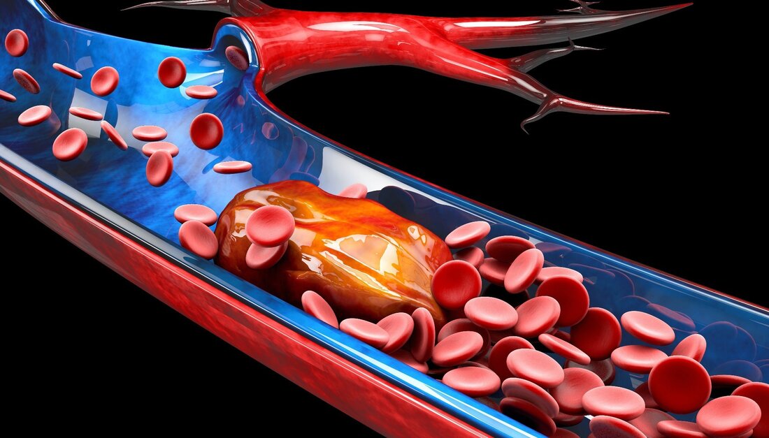 In einer aktuellen Studie veröffentlicht in Thromboseforschungermittelten die Forscher Plasmasignaturen von Proteinen, die mit Blutplättchen in Zusammenhang stehen oder von ihnen abgeleitet sind, bei akuter isolierter Lungenembolie (iPE) und mit tiefer Venenthrombose assoziierter PE (DVT-PE) im Vergleich zu isolierter TVT (iDVT). Lernen: Subtypspezifische Plasmasignaturen der thrombozytenbezogenen Proteinfreisetzung bei akuter Lungenembolie. Bildquelle: Victor Josan/Shutterstock Hintergrund Die beiden primären Subtypen von PE sind iPE und DVT-PE, und Studien haben gezeigt, dass sich die Plasmaproteinprofile für diese beiden Erkrankungen unterscheiden. Blutplättchen fungieren als zelluläre Linker und erleichtern den entzündlichen Crosstalk zwischen Immun- und Endothelzellen bei hoher arterieller Scherbeanspruchung. Bei diesem Prozess handelt es …