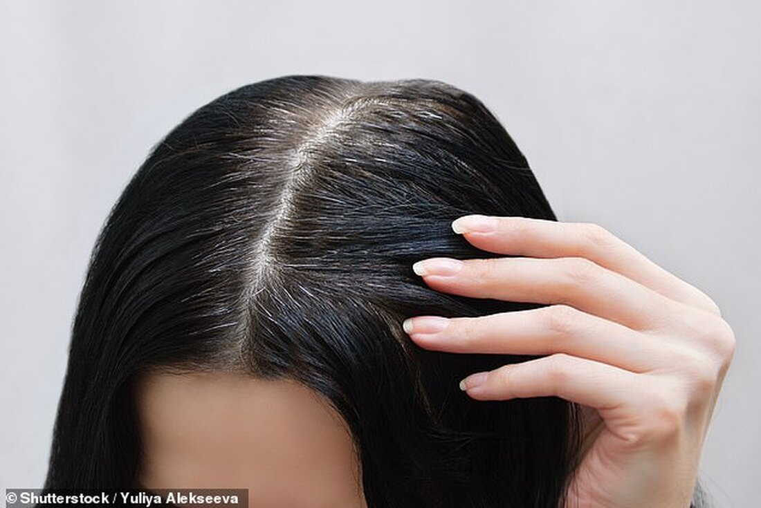 Ich habe seit Jahren Psoriasis auf meiner Kopfhaut und nichts hilft dagegen. Meine Mutter hatte es, meine beiden Kinder und mein Bruder auch. Ich weiß, dass es keine Heilung gibt, aber gibt es neue Behandlungen oder Forschungsergebnisse? Name und Adresse angegeben. Psoriasis ist eine chronisch entzündliche Erkrankung, die typischerweise eine Ansammlung schuppiger Flecken auf der Haut verursacht – das Ergebnis einer Beschleunigung der Produktion von Hautzellen. Als Ursache wird ein Fehler im Immunsystem vermutet. Die Krankheit kann Auswirkungen über die Haut hinaus haben – etwa jeder Dritte der Betroffenen entwickelt beispielsweise eine Form von Arthritis in den Gelenken. Es kann …