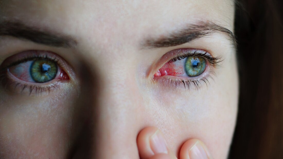 Eine Studie veröffentlicht in Die Augenoberfläche beschreibt den Zusammenhang zwischen Affenpockeninfektion und Augenkomplikationen beim Menschen. Lernen: Affenpocken und Auswirkungen auf die Augen beim Menschen. Bildnachweis: Domaskina/Shutterstock Hintergrund Monkeypox ist ein DNA-Virus, das zur gleichen Orthopox-Gattung wie das Pockenvirus Variola gehört. Es ist ein zoonotisches Virus, das von Tieren auf Menschen überspringt, um Infektionen zu übertragen. Das Virus war ursprünglich in Zentral- und Westafrika endemisch, und die erste menschliche Affenpockeninfektion wurde 1970 in der Demokratischen Republik Kongo festgestellt. Im Jahr 2022 wurden in vielen nicht endemischen Ländern auf der ganzen Welt neue Ausbrüche von Affenpocken-Infektionen dokumentiert. Dieser plötzliche Anstieg der Fälle …