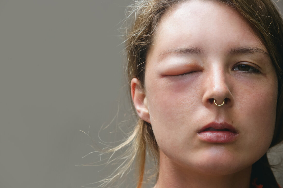 Das Hereditäre Angioödem (HAE) ist eine genetische Erkrankung, die durch Mutationen verursacht wird, welche zu einer übermäßigen Produktion von Bradykinin führen. Dieses Protein erweitert die Blutgefäße und ermöglicht den Austritt von Flüssigkeit aus dem Blutkreislauf ins umliegende Gewebe – was zu den typischen Schwellungen führt. Plötzliche Schwellungsattacken sind das Hauptsymptom von HAE. Doch viele Betroffene leiden auch unter weiteren Beschwerden, die entweder zusammen mit einer Schwellung oder sogar ohne sie auftreten können. Plötzliche Schwellungsattacken sind das Hauptsymptom von HAE. Doch viele Betroffene leiden auch unter weiteren Beschwerden, die entweder zusammen mit einer Schwellung oder sogar ohne sie auftreten können. HAE-Symptome &hellip;