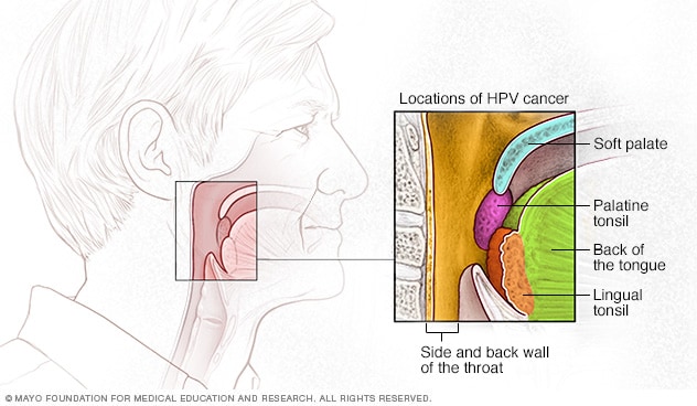 HPV erhöht das Risiko für Krebs im Rachen, im weichen Gaumen, in den Mandeln und im Zungenrücken.