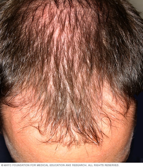 Bei Männern beginnen die Haare oft, sich von der Stirn zurückzuziehen.