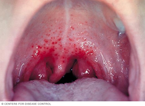 Bild einer Streptokokkeninfektion
