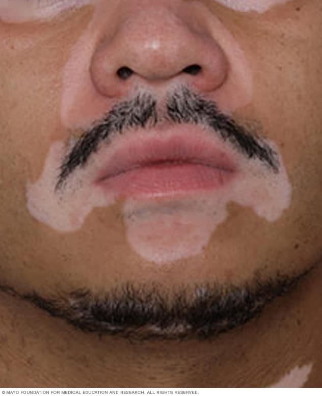 Vitiligo-Flecken im Gesicht