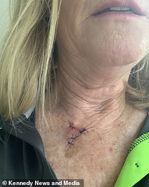 Frau Murray im Bild mit gut heilender Wunde