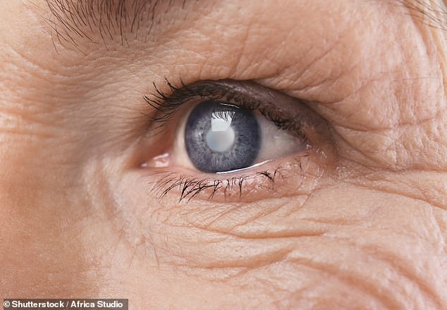 Kataraktoperationen gelten als Routine, von denen allein in England jedes Jahr etwa 330.000 vom NHS durchgeführt werden.  Der Grund, warum wir operieren, ist, dass Katarakte – Trübung der Linse an der Vorderseite des Auges – normalerweise mit der Zeit schlimmer werden und zu Sehverlust führen.  (Dateibild)