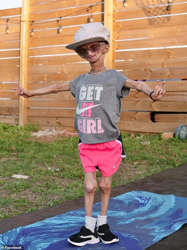 Dr. James Liu, ein Genetiker, der es entwickelt hat, sagte, das Gerät könne verwendet werden, um Patienten wie Adalia Rose (im Bild) zu helfen, die im Alter von 15 Jahren an der genetischen Erkrankung Progerie starb, die dazu führt, dass der Körper schnell altert und nicht normal wächst